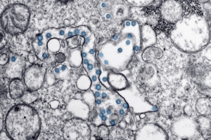 Yale Araştırmacıları Parkinson'da Protein Birikimini Durdurdu